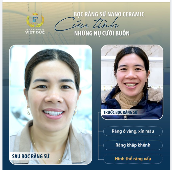 SỞ HỮU NỤ CƯỜI ĐẸP CÙNG BỌC RĂNG SỨ NANO CERAMIC