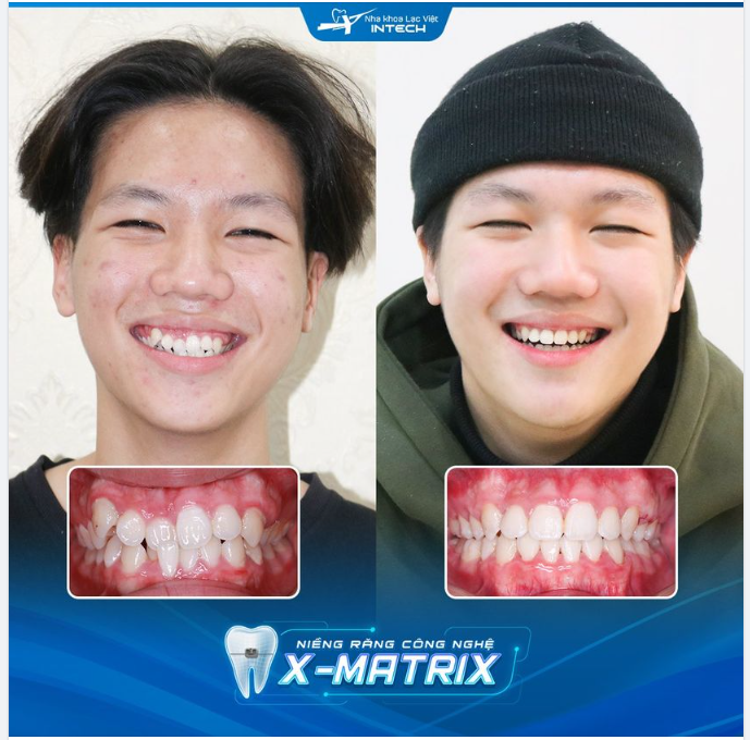 SỞ HỮU NỤ CƯỜI HOÀN HẢO SAU 19 THÁNG NIỀNG RĂNG X-MATRIX