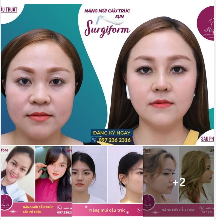 SỞ HỮU THẦN THÁi NGÚT NGÀN VỚI NÂNG MŨI SURGIFORM