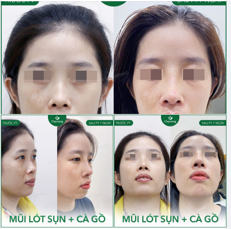 Sóng mũi của nhiều bạn vốn dĩ đã cao nhưng lại thiếu đẹp vì…gồ mũi.
