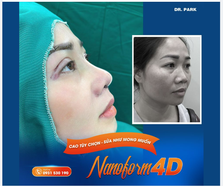 SỰ KHÁC BIỆT CỦA NÂNG MŨI CẤU TRÚC NANOFORM