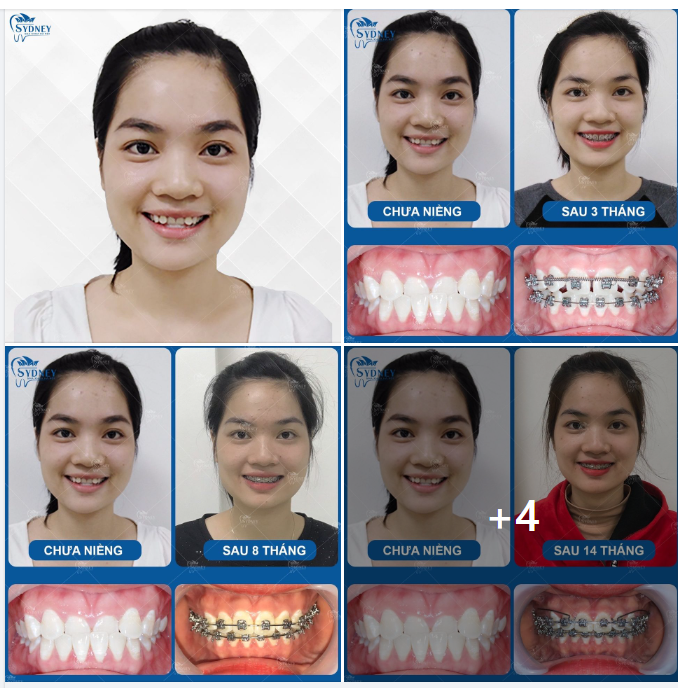 SỰ THAY ĐỔI NGOẠN MỤC TRƯỚC VÀ SAU KHI NIỀNG RĂNG MÓM