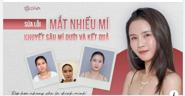 SỬA LỖI THẨM MỸ MẮT NHIỀU MÍ, SẸO NẾP MÍ, KHUYẾT SÂU VÙNG MÍ DƯỚI VÀ KẾT QUẢ