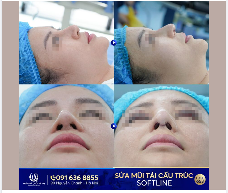 Sửa mũi lần 4 - Sửa mũi tái cấu trúc Softline