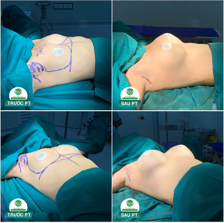 SỨC NÓNG TẠI PHÒNG PT VỚI KẾT QUẢ ĐẸP HOÀN HẢO