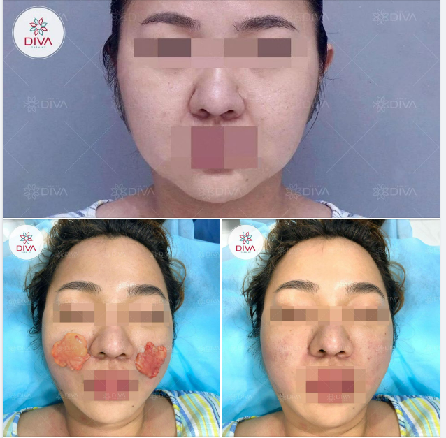 TÁCH TÚI MỠ MÁ - BẠN ĐƯỢC GÌ