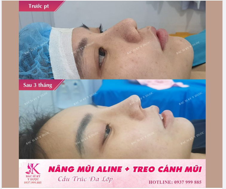 TÁI KHÁM DÁNG MŨI ALINE CẤU TRÚC ĐA LỚP + TREO CÁNH MŨI + LÀM MỎNG CÁNH MŨI