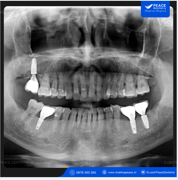 TÁI KHÁM IMPLANT SAU 6 NĂM