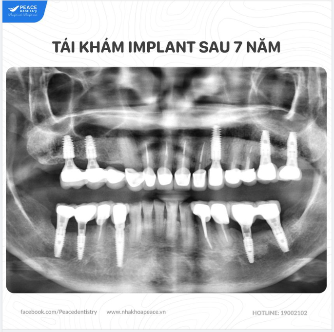 TÁI KHÁM IMPLANT SAU 7 NĂM
