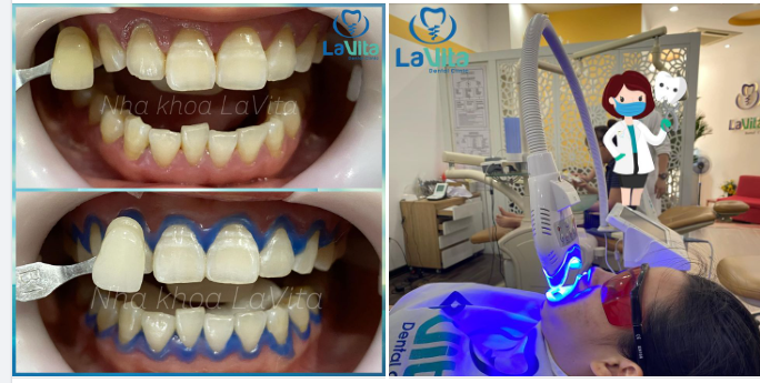 TẠI SAO BẠN NÊN LỰA CHỌN TẨY TRẮNG RĂNG TẠI NHA KHOA LAVITA?