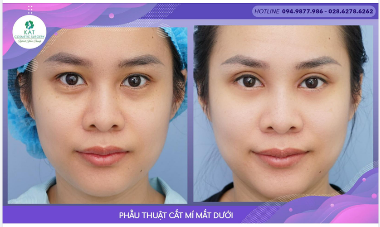 Tại sao nhiều bạn trẻ phải Phẫu thuật cắt mí dưới