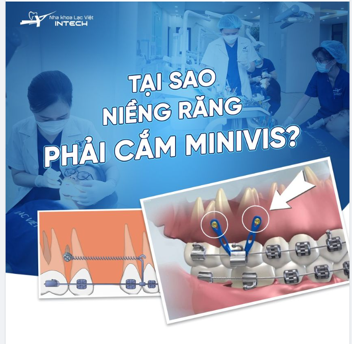 TẠI SAO PHẢI CẮM MINIVIS KHI NIỀNG RĂNG?