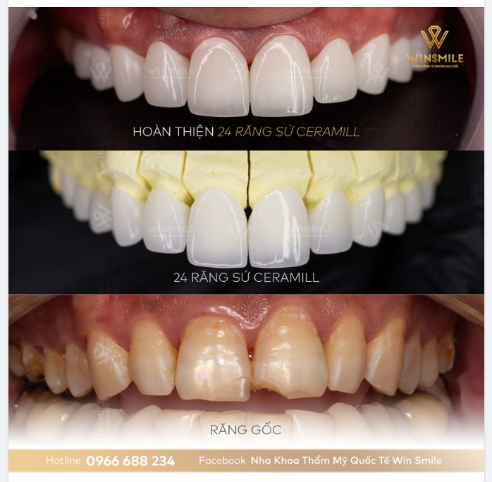 TÁI TẠO NỤ CƯỜI – THANH XUÂN TRỞ LẠI NHỜ RĂNG SỨ CERAMILL