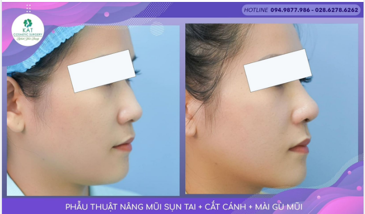 “Tạm biệt chiếc mũi gồ khiến bạn không tự tin ​​​​​​​”