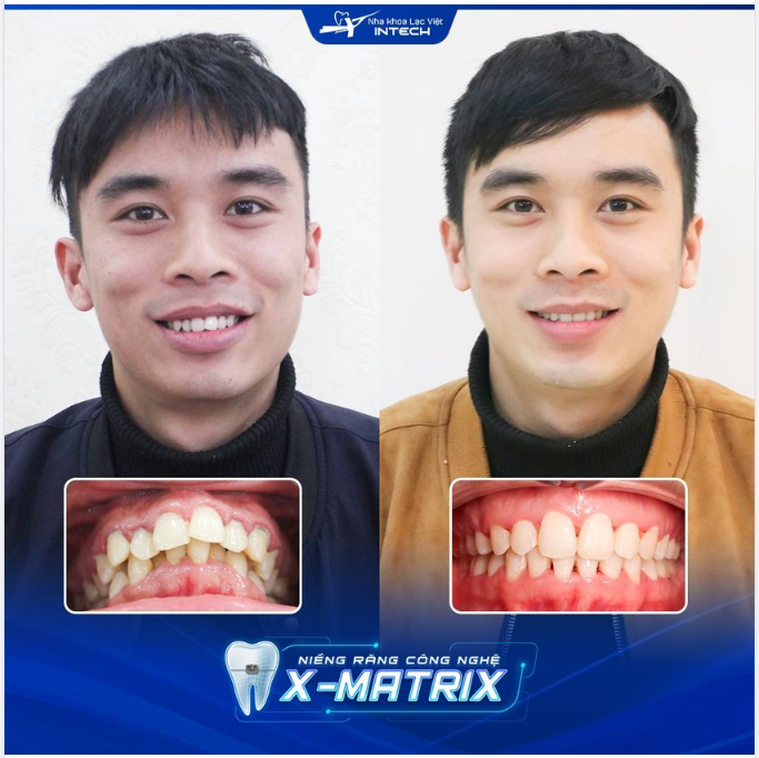 TẠM BIỆT RĂNG HÔ NHỜ CÔNG NGHỆ X-MATRIX