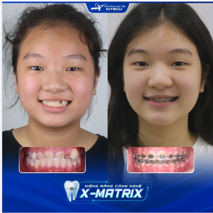 TẠM BIỆT RĂNG MÓM SAU 15 THÁNG NIỀNG RĂNG CÔNG NGHỆ X-MATRIX