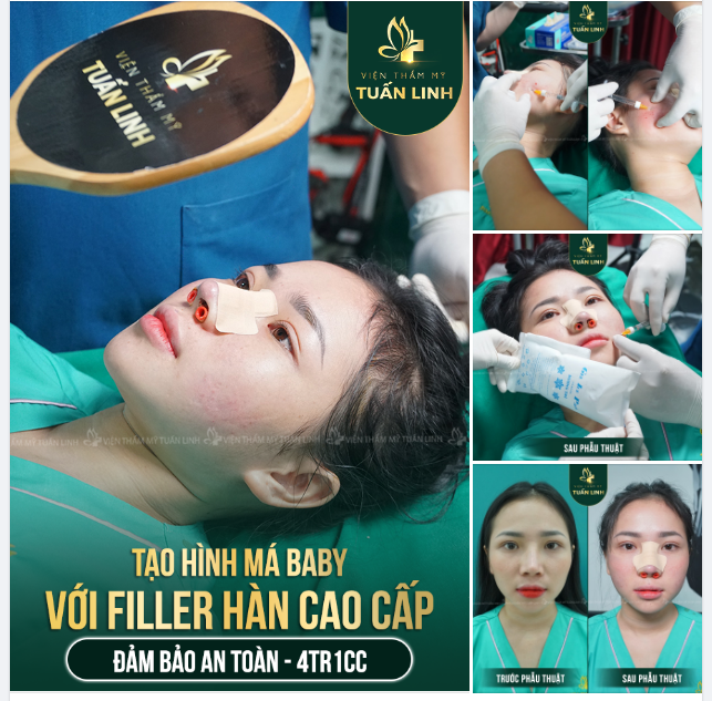 TẠO HÌNH MÁ BABY CHO KHUÔN MẶT TRẺ TRUNG XINH ĐẸP BẰNG FILLER CAO CẤP