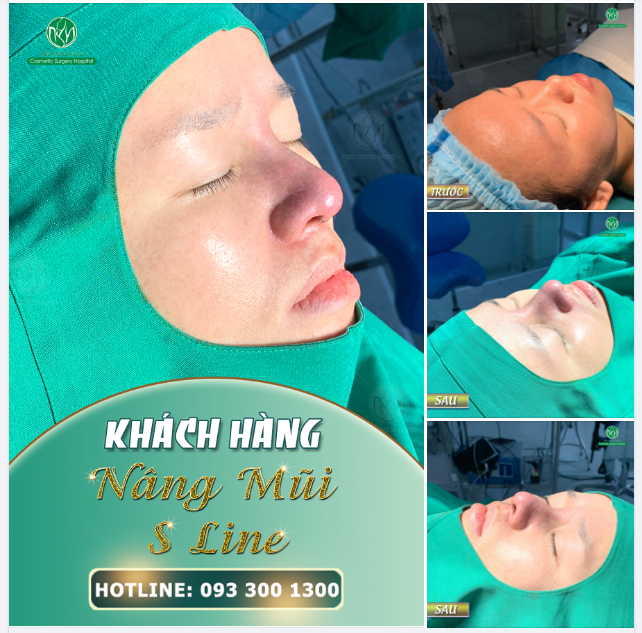 TẠO HÌNH MŨI S LINE ĐẸP NGAY SAU THỰC HIỆN