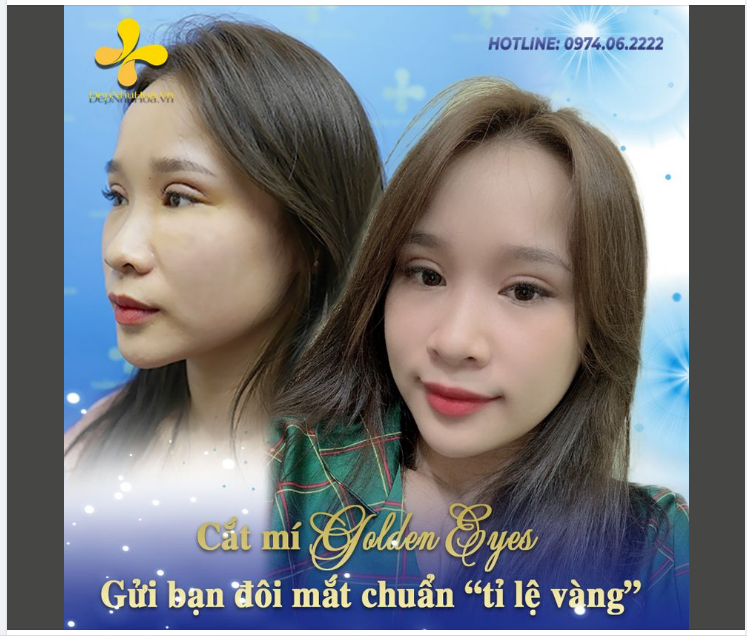 Tạo hình nếp mí sắc nét, to tròn nhờ phương pháp CẮT MÍ GOLDEN EYES