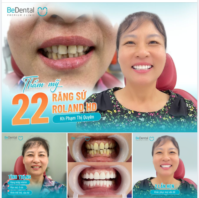 Thẩm mỹ hàm răng không chỉ để đẹp mà còn cải thiện chức năng ăn nhai, hết bệnh lý răng miệng