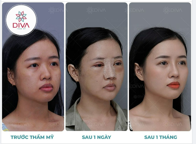 THẨM MỸ NÂNG MŨI – ĐÂU LÀ CÔNG ĐOẠN QUAN TRỌNG TẠO RA CHIẾC MŨI ĐẸP