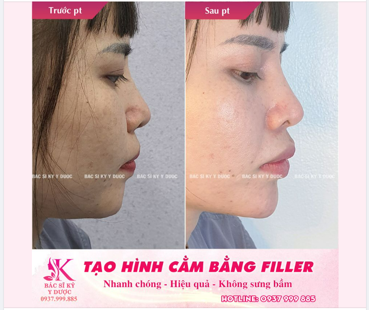 THẨM MỸ NỘI KHOA - LÀM ĐẸP KHÔNG CẦN PHẪU THUẬT TẠO HÌNH BẰNG FILLER