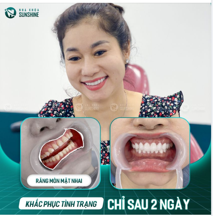 Thẩm mỹ răng sứ - Giải pháp tối ưu dành cho răng mòn mặt nhai.