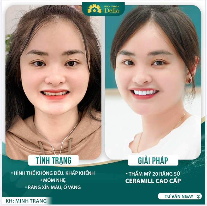 Thẩm mỹ răng sứ - Tìm lại nụ cười tươi tắn