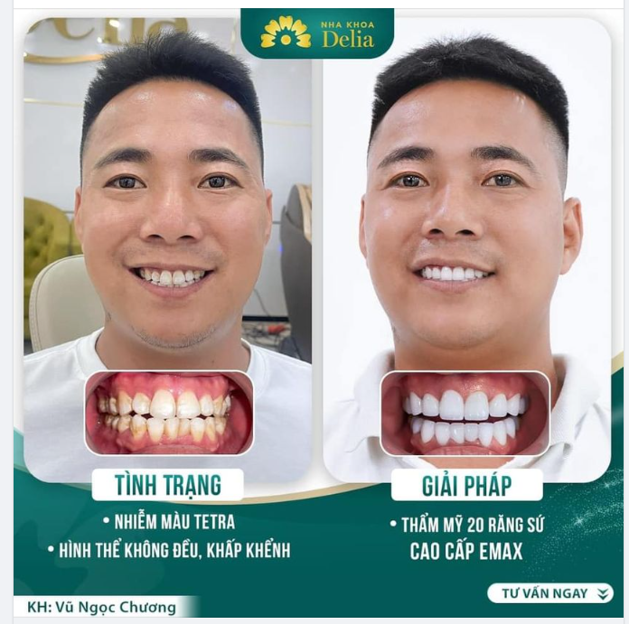 THẨM MỸ RĂNG SỨ - TỰ TIN NỤ CƯỜI PHÁI MẠNH