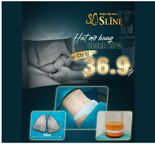 THÁNG VÀNG cho nàng đi hút mỡ bụng