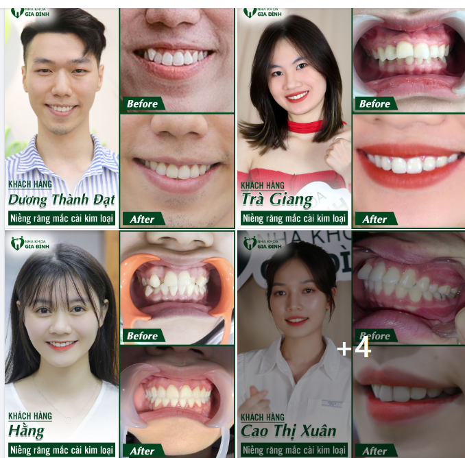 THÀNH TRAI XINH, GÁI ĐẸP HẾT SAU KHI NIỀNG RĂNG TẠI NHA KHOA GIA ĐÌNH