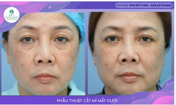 “Thanh xuân trở lại chỉ với cắt mí dưới ”