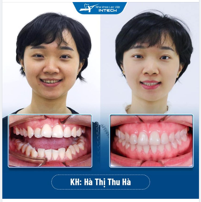 THÁO MẮC CÀI - ĐÓN NỤ CƯỜI TỰ TIN NHỜ NIỀNG RĂNG X-MATRIX