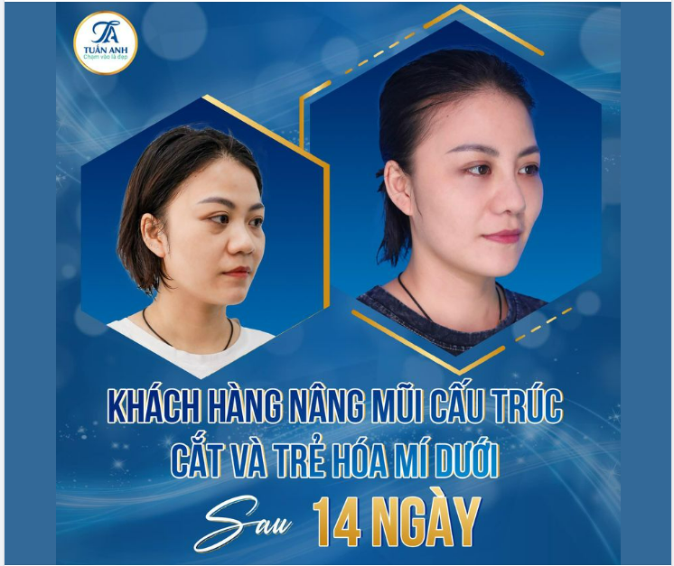 Thay diện mạo, đổi thần thái với combo. NÂNG MŨI CẤU TRÚC,  CẮT VÀ TRẺ HOÁ MÍ DƯỚI