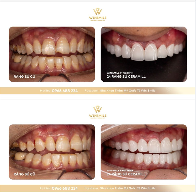 THAY DIỆN MẠO MỚI CHO NỤ CƯỜI VỚI CERAMILL 