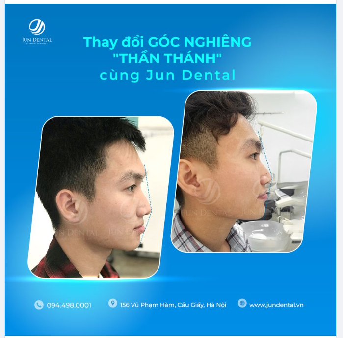 THAY ĐỔI GÓC NGHIÊNG "THẦN THÁNH" CÙNG JUN DENTAL