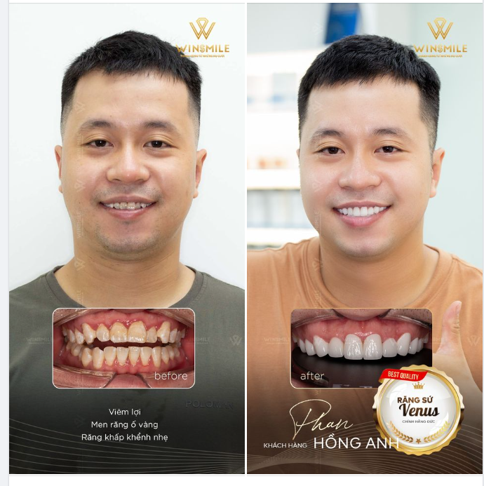 THAY NỤ CƯỜI, ĐỔI THẦN THÁI SAU KHI LÀM RĂNG SỨ