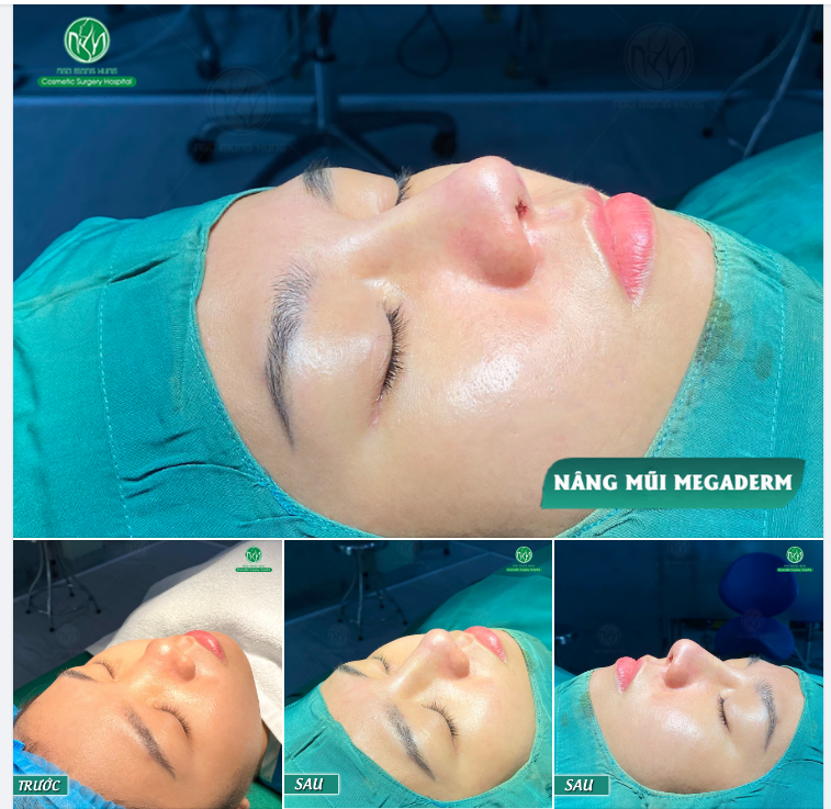 THÊM MỘT KẾT QUẢ SAU NÂNG MŨI MEGADERM