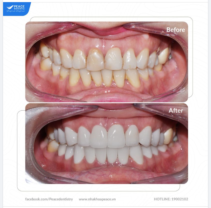 Thiết kế lại nụ cười với mặt dán sứ và bọc răng sứ thẩm mỹ