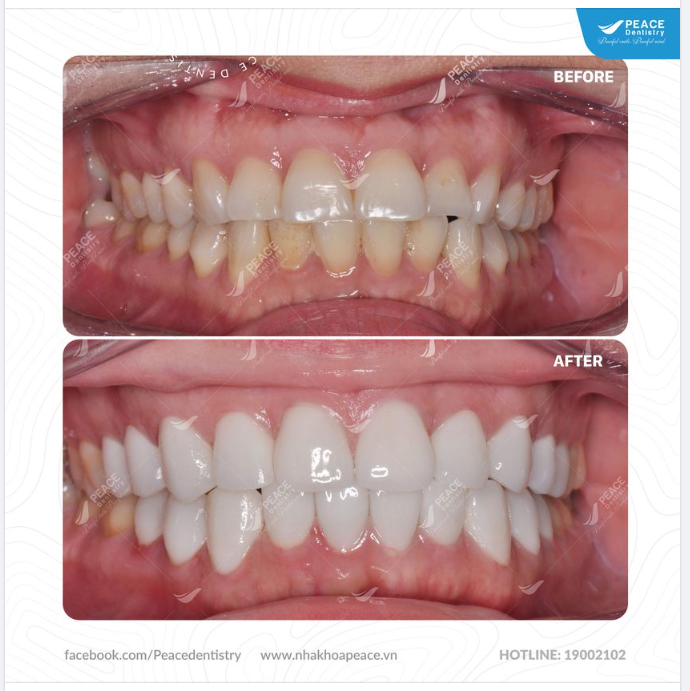 Thiết kế lại nụ cười với mặt dán sứ Veneer