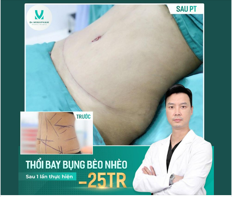 Thổi bay bụng bèo nhèo sau 1 lần thực hiện hút m.ỡ tạo hình thành bụng