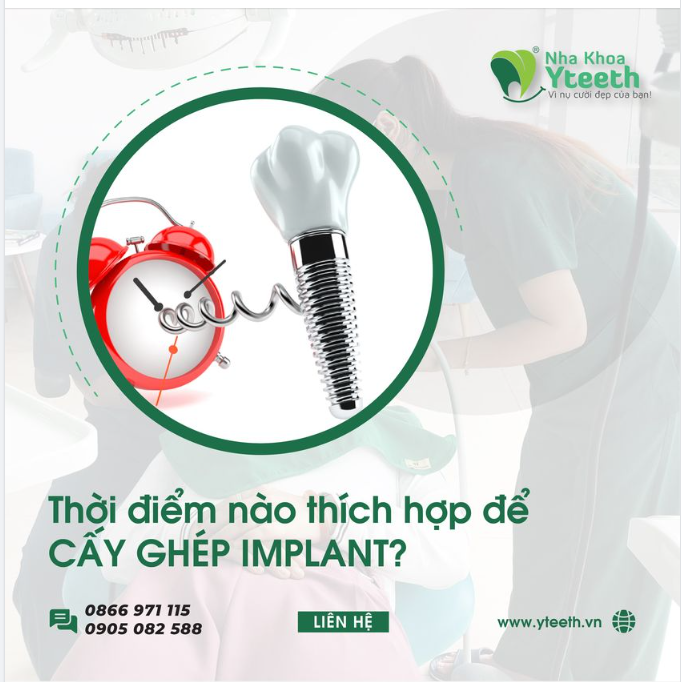 THỜI ĐIỂM THÍCH HỢP NHẤT ĐỂ CẤY GHÉP IMPLANT