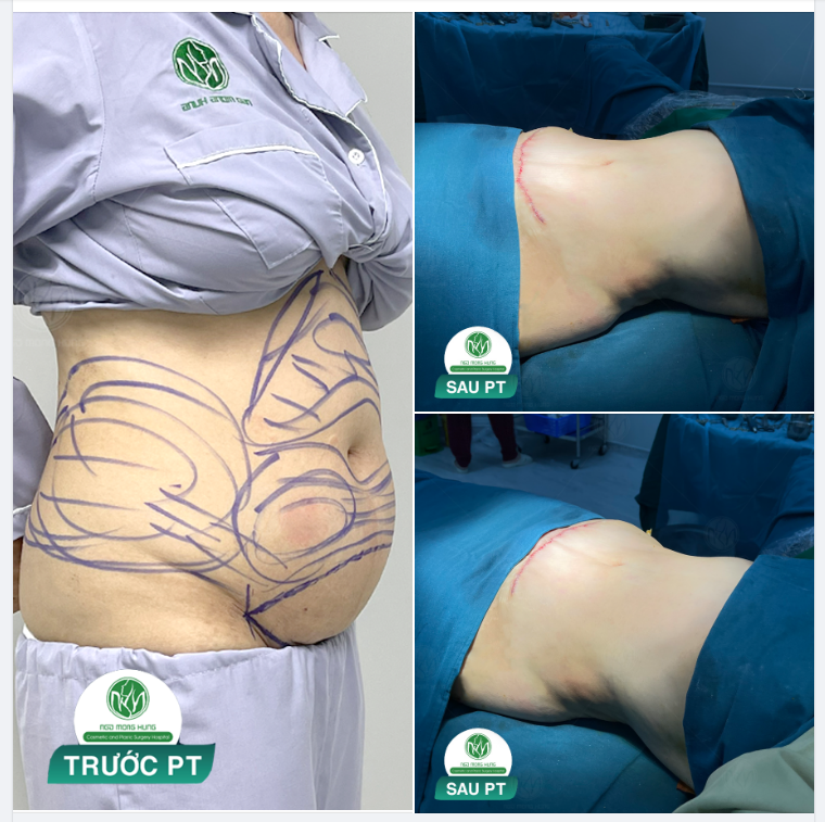 THON GỌN HƠN VỚI COMBO HÚT MỠ KẾT HỢP CĂNG DA BỤNG