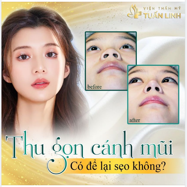 Thu gọn cánh mũi có để lại sẹo không