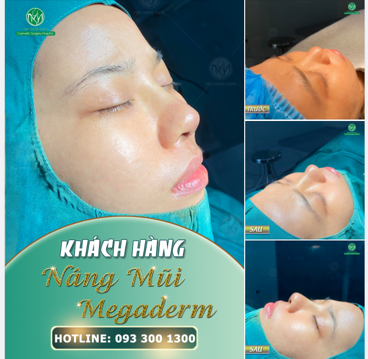 THU HÚT HƠN NHỜ DÁNG MŨI MEGADERM