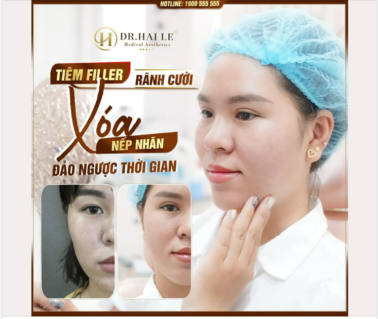 TIÊM FILLER RÃNH CƯỜI - ĐEM TỚI NÉT ĐẸP VƯỢT THỜI GIAN