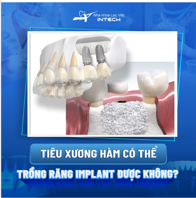 TIÊU XƯƠNG HÀM CÓ THỂ TRỒNG RĂNG IMPLANT ĐƯỢC KHÔNG?