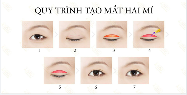 Tìm hiểu về quy trình cắt mí Plasma tại PTTM Bác sĩ Long