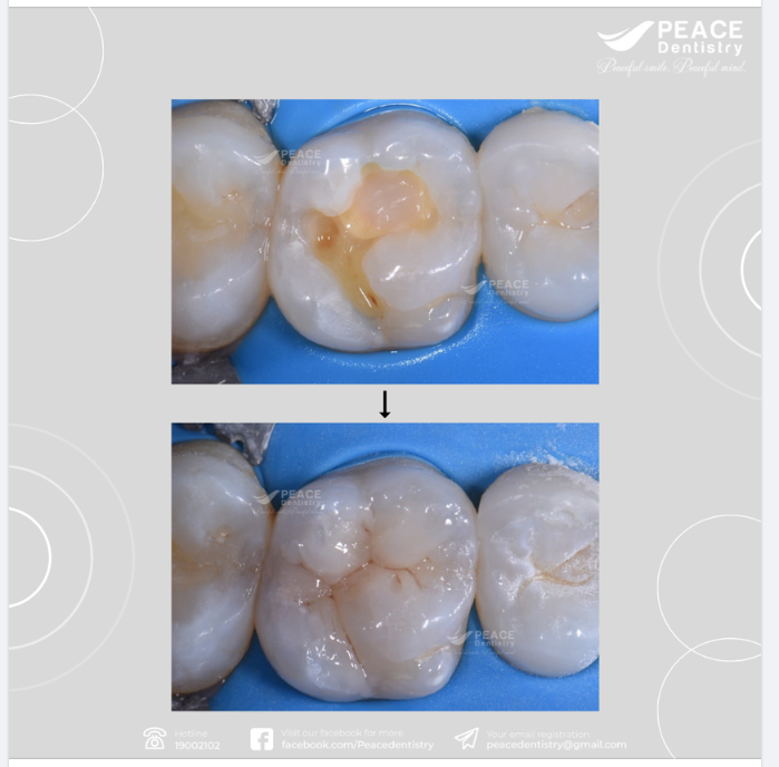 TRÁM RĂNG SÂU BẰNG CÔNG NGHỆ HALOGEN QUANG TRÙNG HỢP