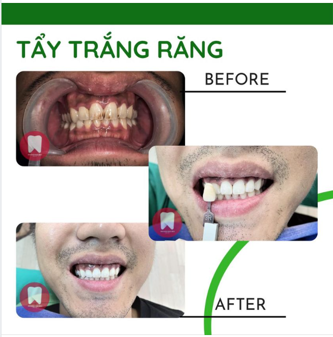 TRẮNG BẬT TONE - KHÔNG Ê BUỐT